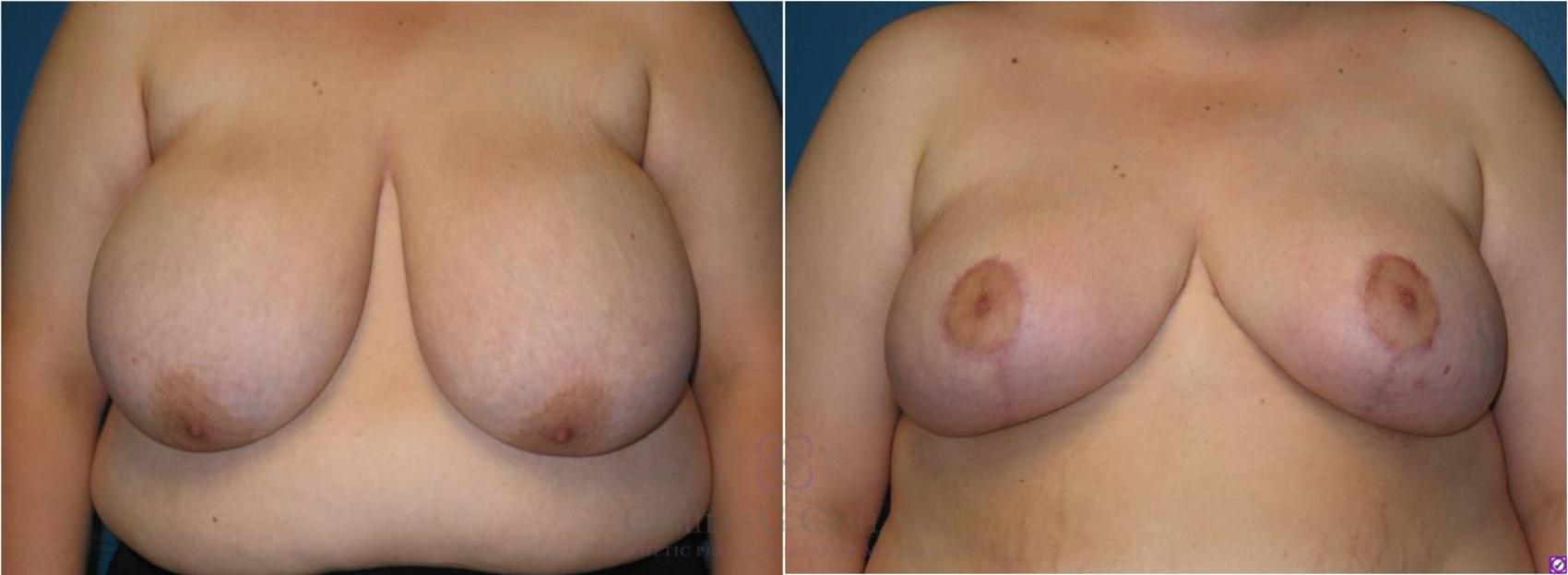 Before & After Breast Reduction Case 17 View #1 View in Houston, TX