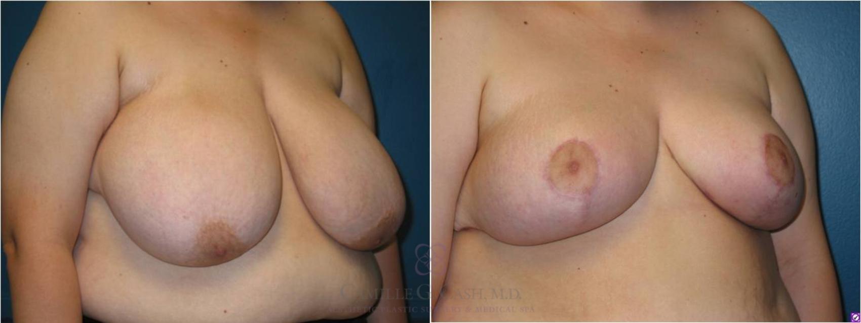 Before & After Breast Reduction Case 17 View #2 View in Houston, TX
