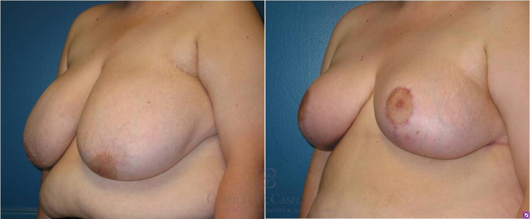 Before & After Breast Reduction Case 17 View #3 View in Houston, TX