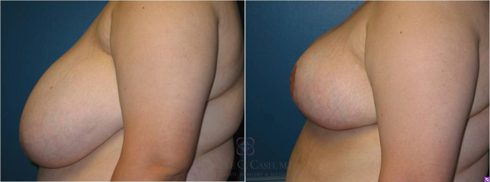 Before & After Breast Reduction Case 17 View #4 View in Houston, TX