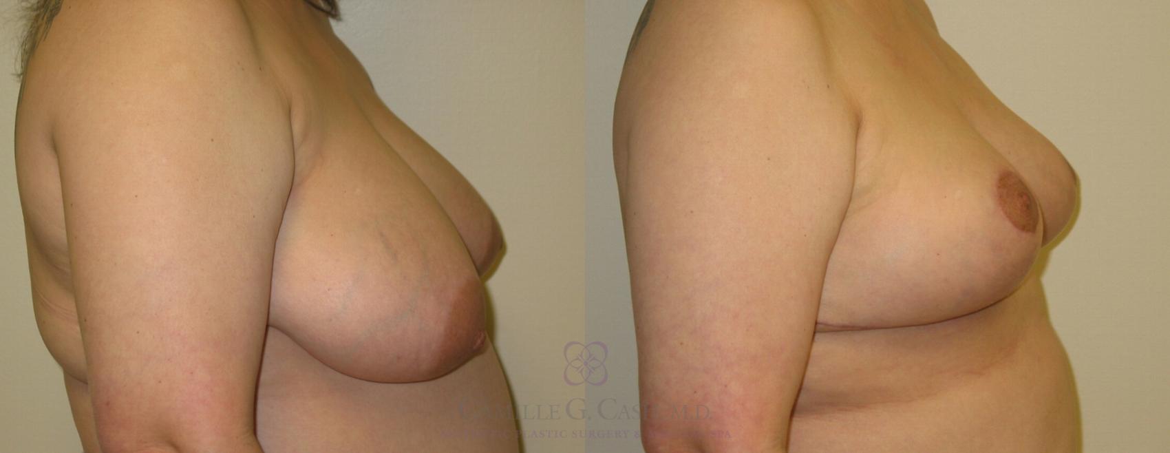 Before & After Breast Reduction Case 177 View #2 View in Houston, TX