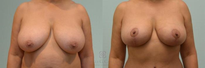 Before & After Breast Reduction Case 242 View #1 View in Houston, TX