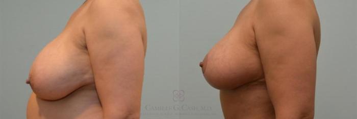 Before & After Breast Reduction Case 242 View #2 View in Houston, TX