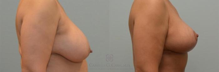 Before & After Breast Reduction Case 242 View #3 View in Houston, TX