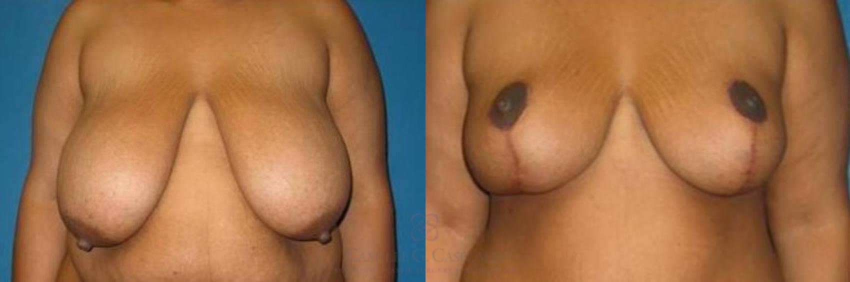 Before & After Breast Reduction Case 260 View #1 View in Houston, TX