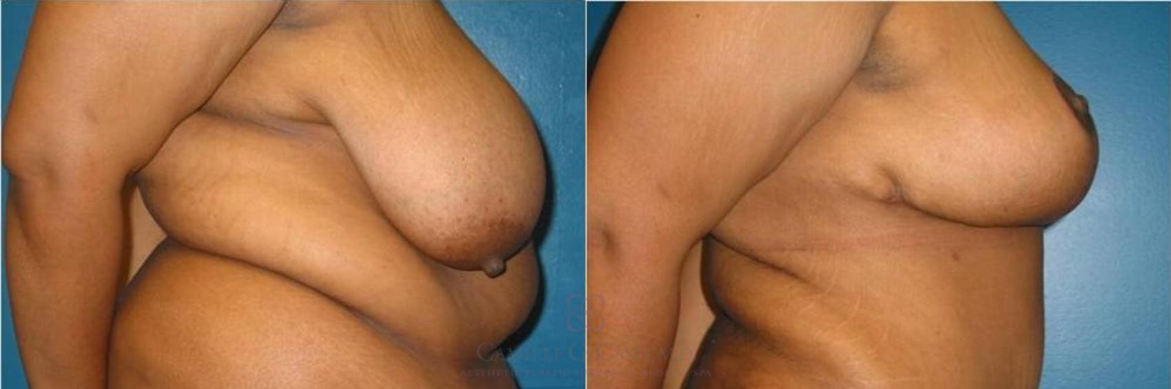 Before & After Breast Reduction Case 260 View #2 View in Houston, TX