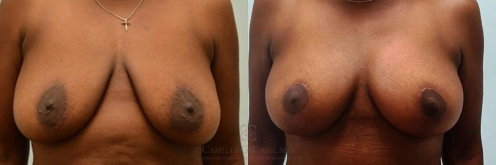 Before & After Breast Reduction Case 267 View #1 View in Houston, TX