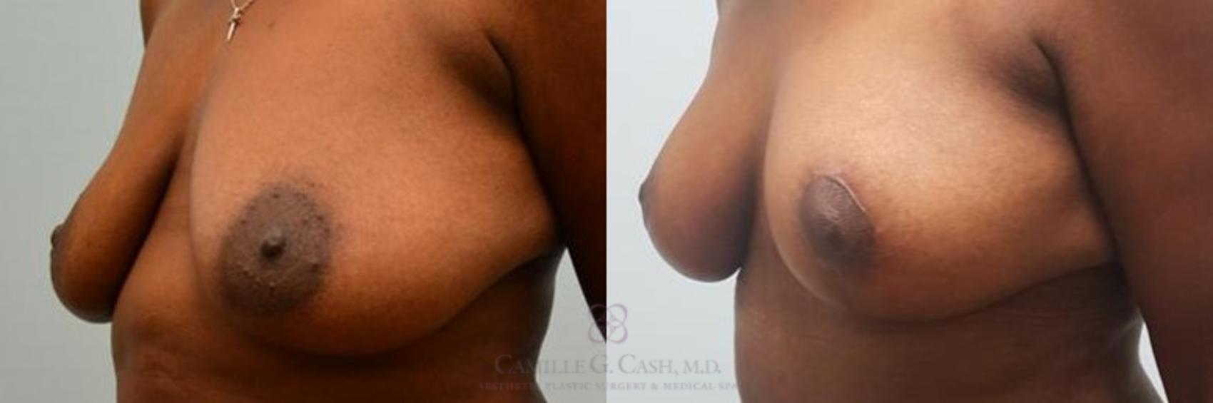Before & After Breast Reduction Case 267 View #2 View in Houston, TX