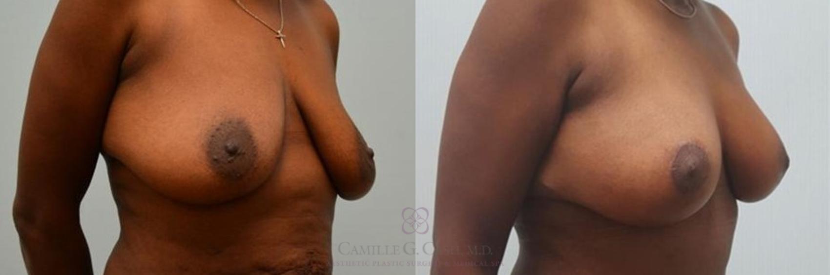 Before & After Breast Reduction Case 267 View #3 View in Houston, TX