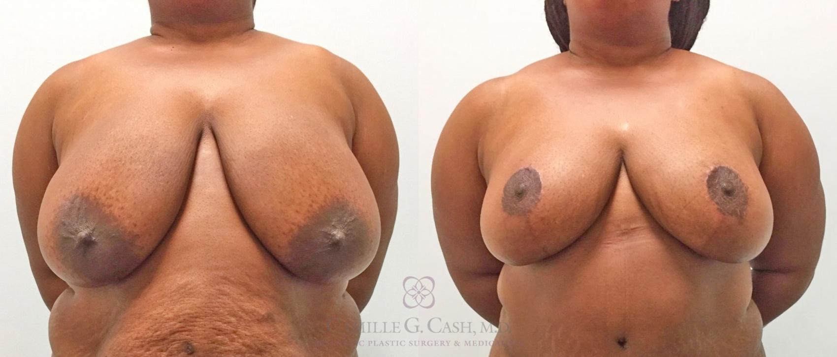Before & After Breast Reduction Case 315 View #1 View in Houston, TX