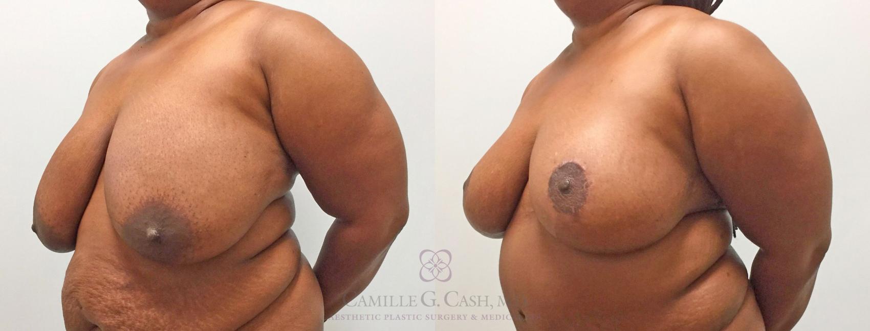 Before & After Breast Reduction Case 315 View #2 View in Houston, TX