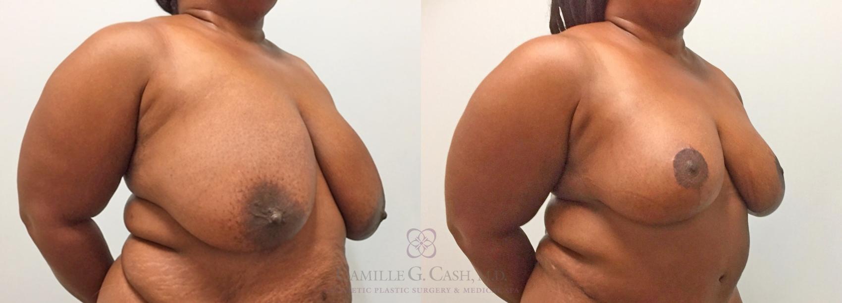 Before & After Breast Reduction Case 315 View #3 View in Houston, TX