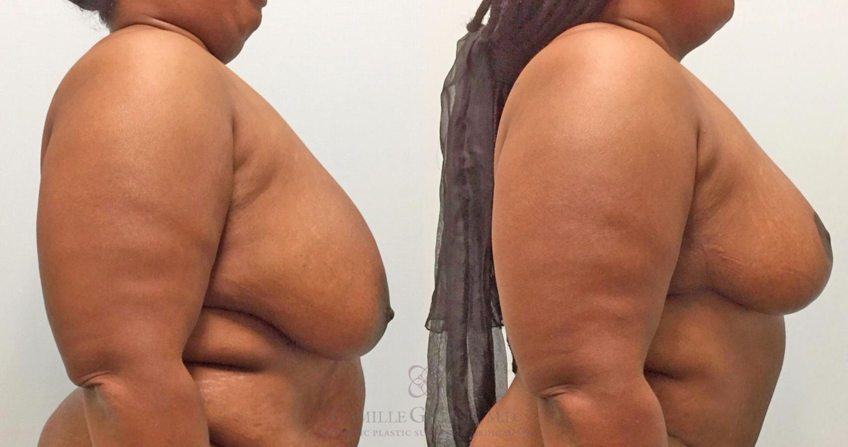 Before & After Breast Reduction Case 315 View #4 View in Houston, TX