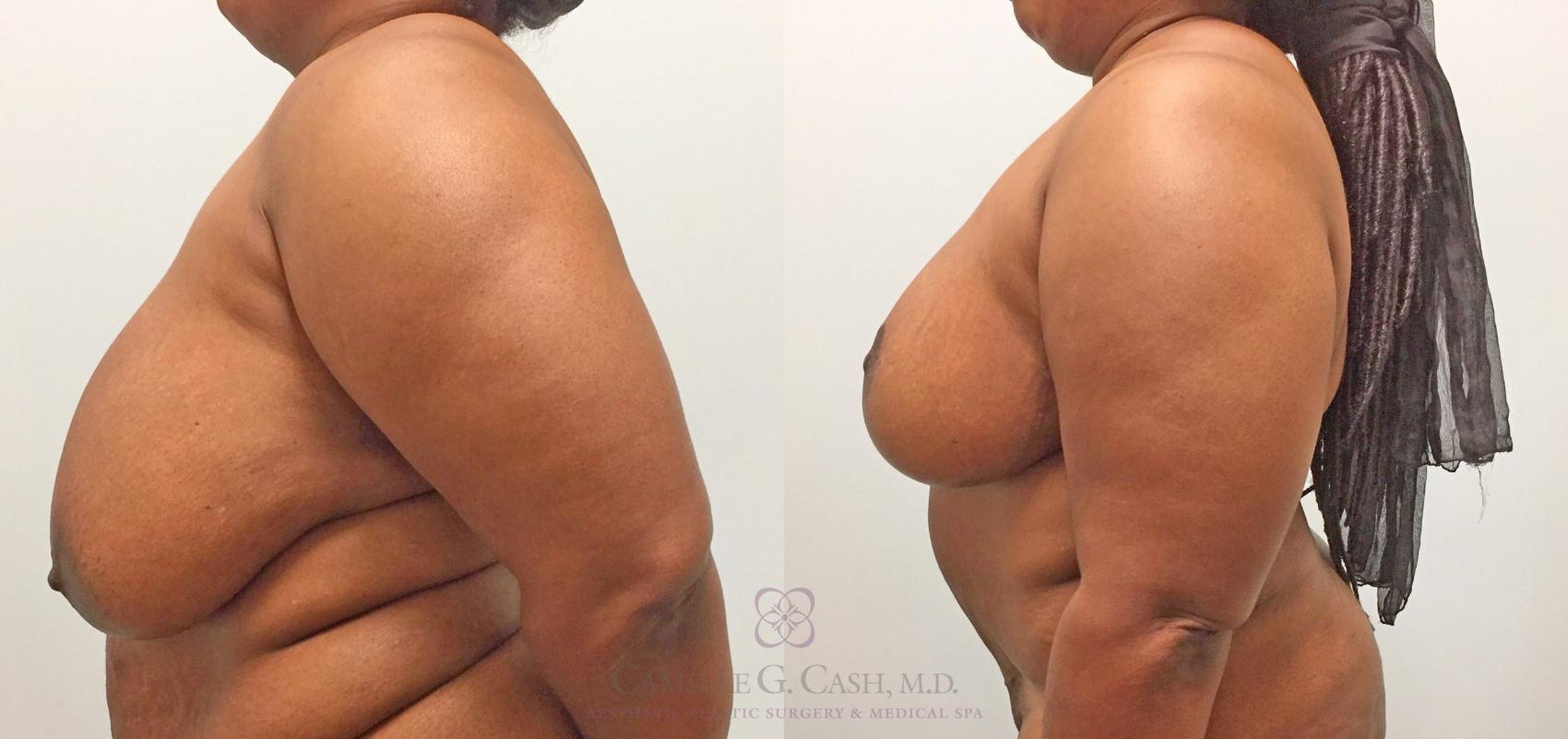 Before & After Breast Reduction Case 315 View #5 View in Houston, TX
