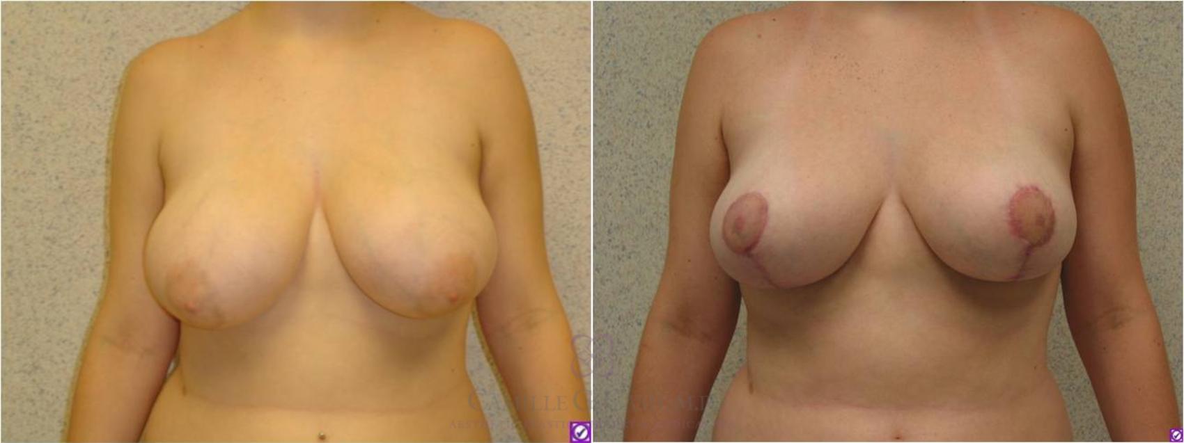 Before & After Breast Reduction Case 35 View #1 View in Houston, TX