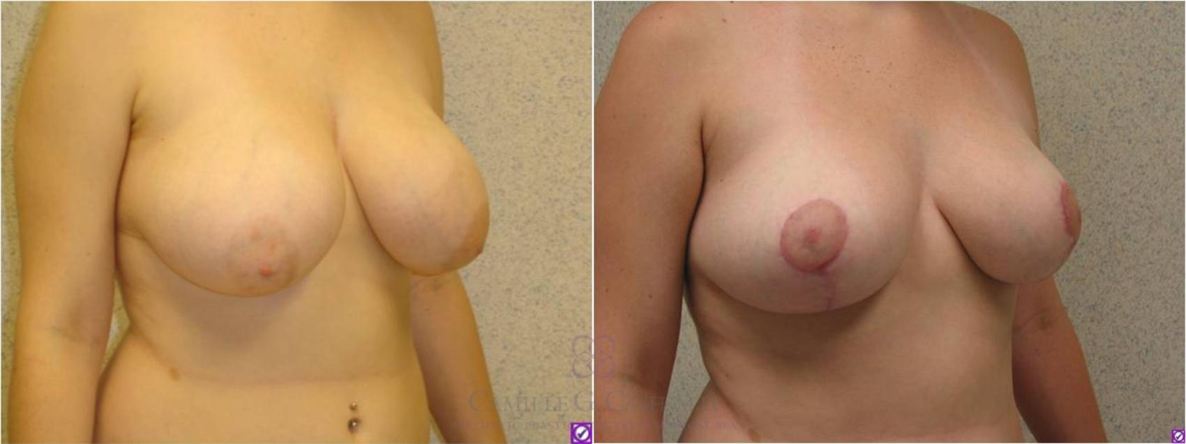 Before & After Breast Reduction Case 35 View #2 View in Houston, TX