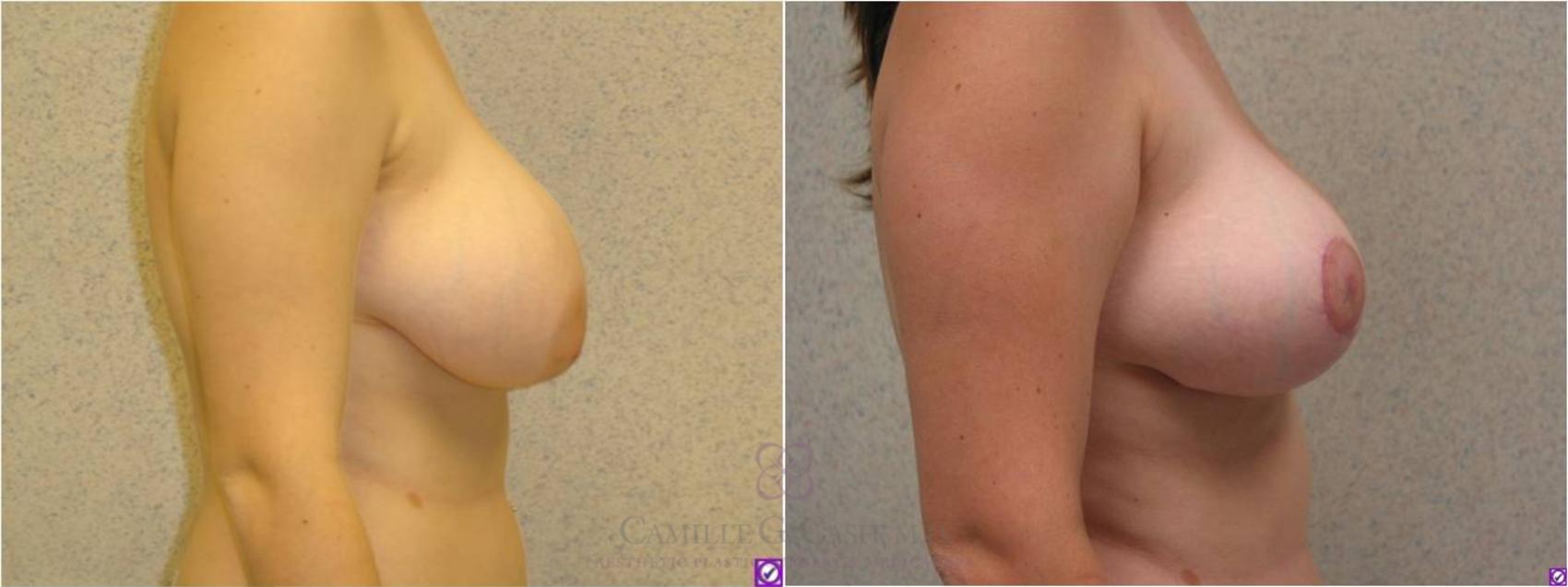 Before & After Breast Reduction Case 35 View #3 View in Houston, TX