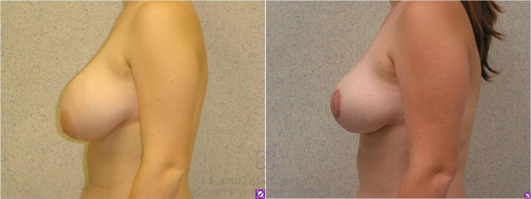 Before & After Breast Reduction Case 35 View #4 View in Houston, TX
