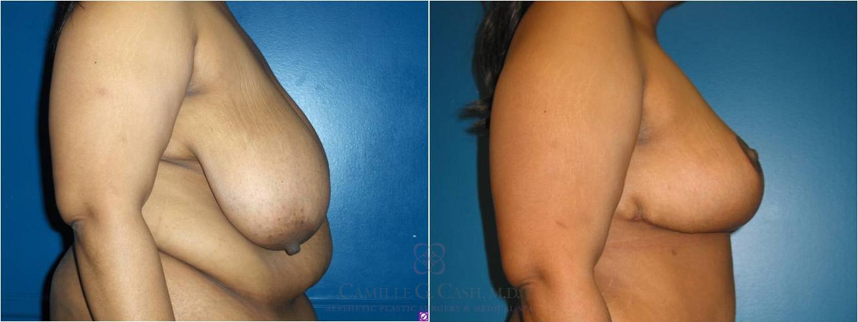 Before & After Breast Reduction Case 37 View #1 View in Houston, TX