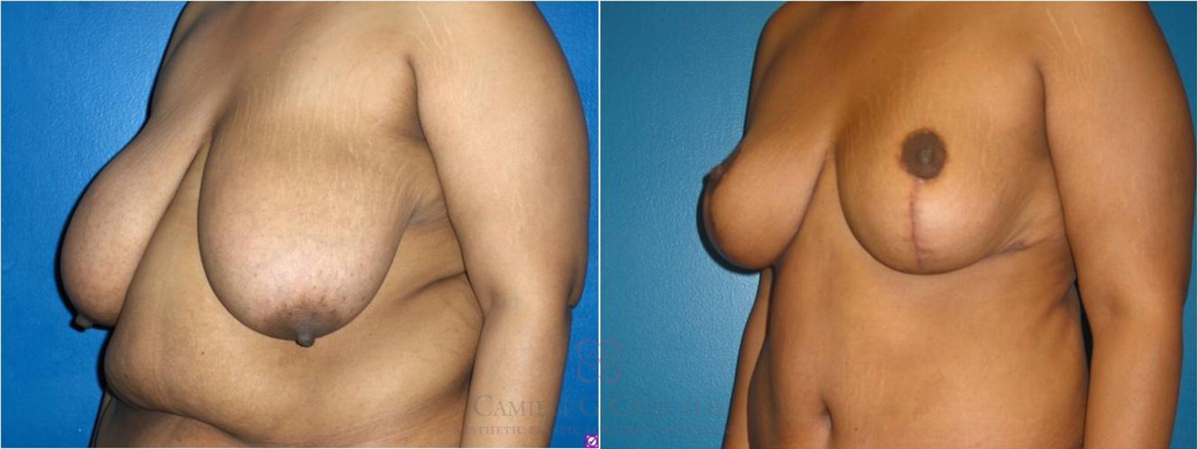 Before & After Breast Reduction Case 37 View #2 View in Houston, TX