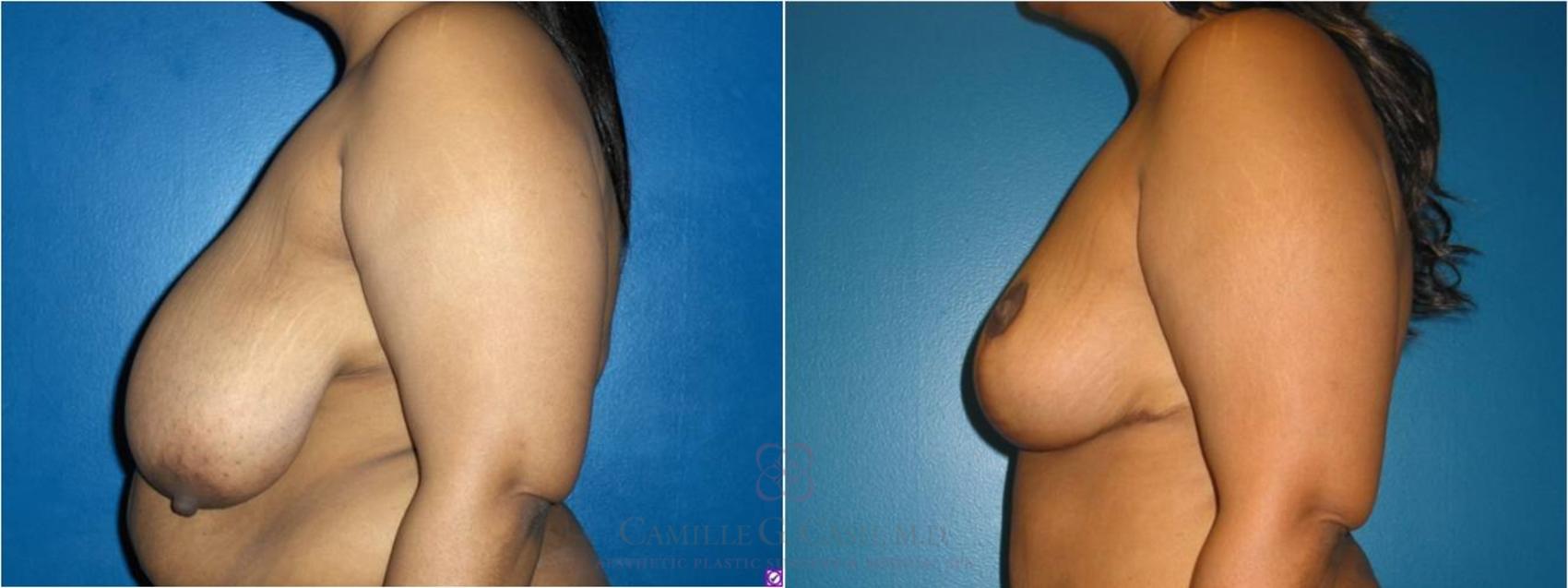 Before & After Breast Reduction Case 37 View #3 View in Houston, TX