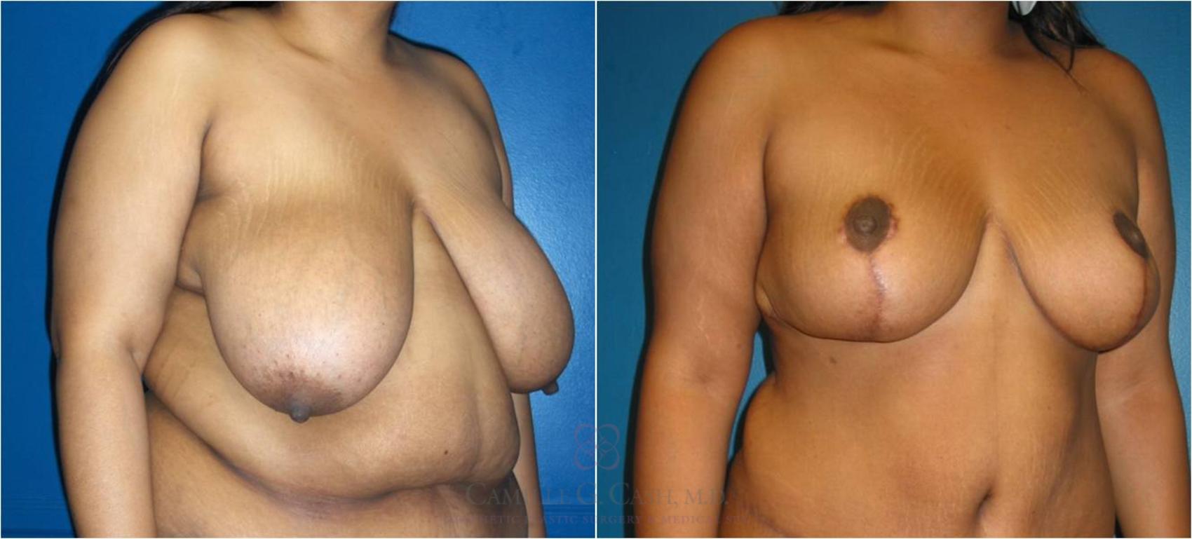 Before & After Breast Reduction Case 37 View #4 View in Houston, TX
