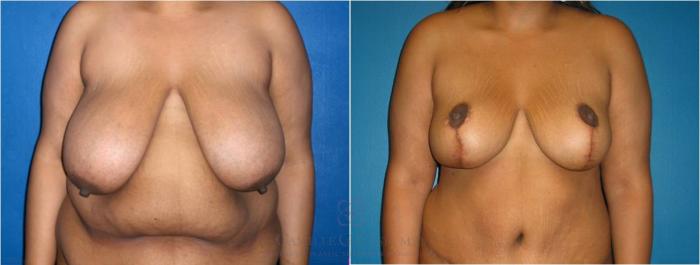 Before & After Breast Reduction Case 37 View #5 View in Houston, TX