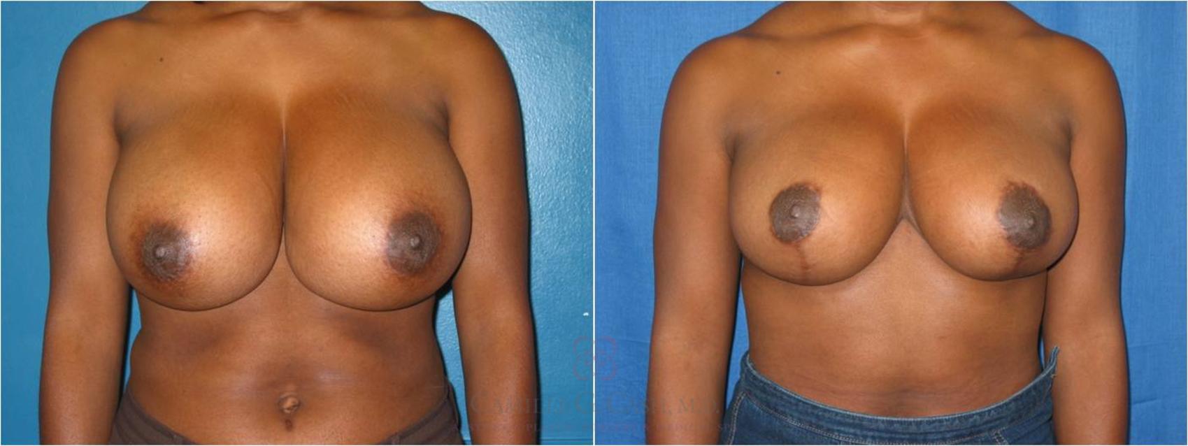 Before & After Breast Reduction Case 39 View #1 View in Houston, TX