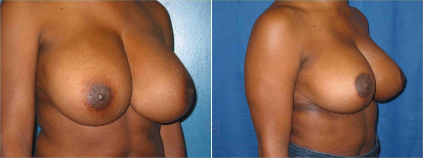 Before & After Breast Reduction Case 39 View #2 View in Houston, TX
