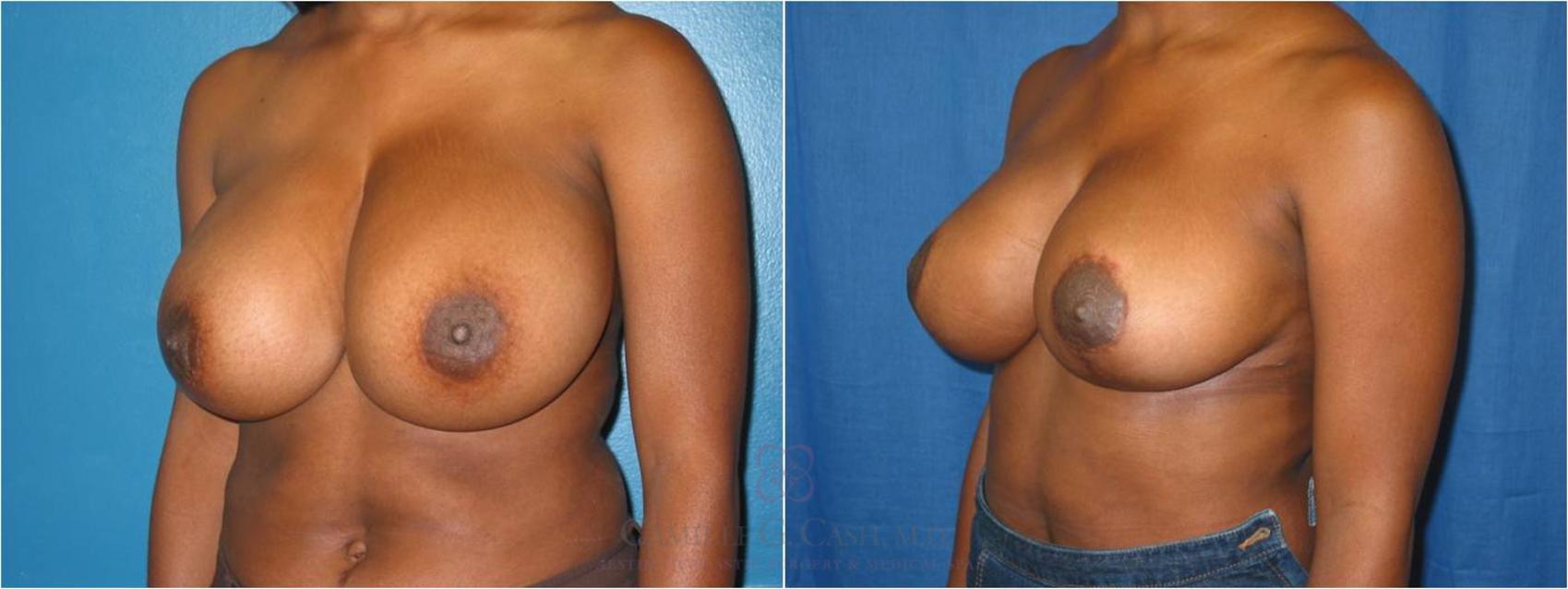 Before & After Breast Reduction Case 39 View #3 View in Houston, TX