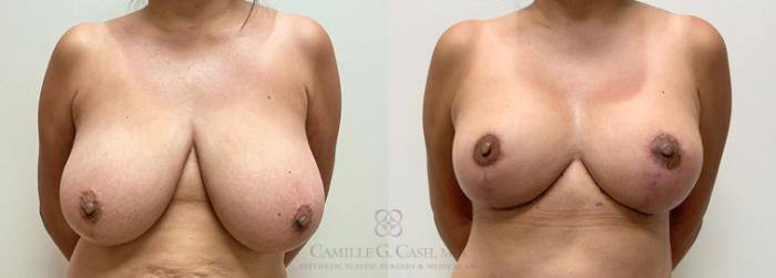 Before & After Breast Reduction Case 398 View #1 View in Houston, TX