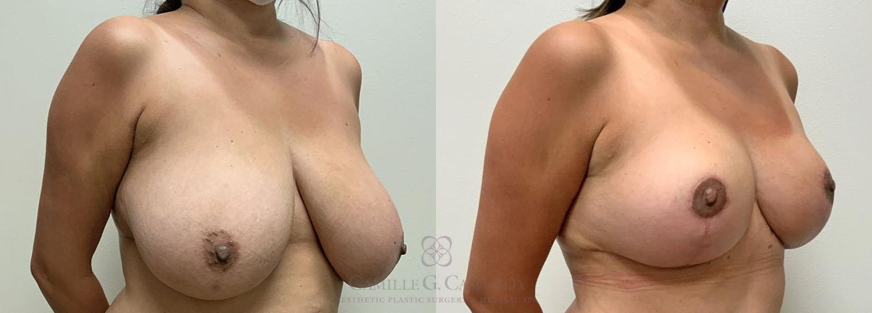Before & After Breast Reduction Case 398 View #2 View in Houston, TX