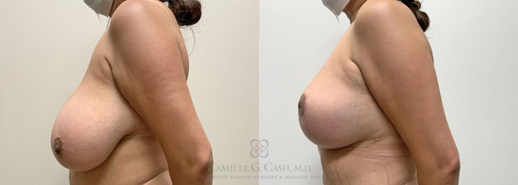 Before & After Breast Reduction Case 398 View #4 View in Houston, TX