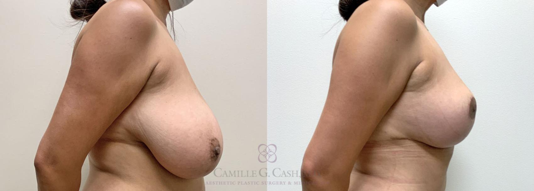 Before & After Breast Reduction Case 398 View #5 View in Houston, TX