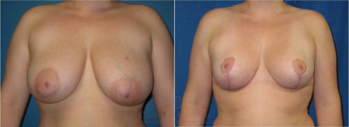 Before & After Breast Reduction Case 40 View #1 View in Houston, TX