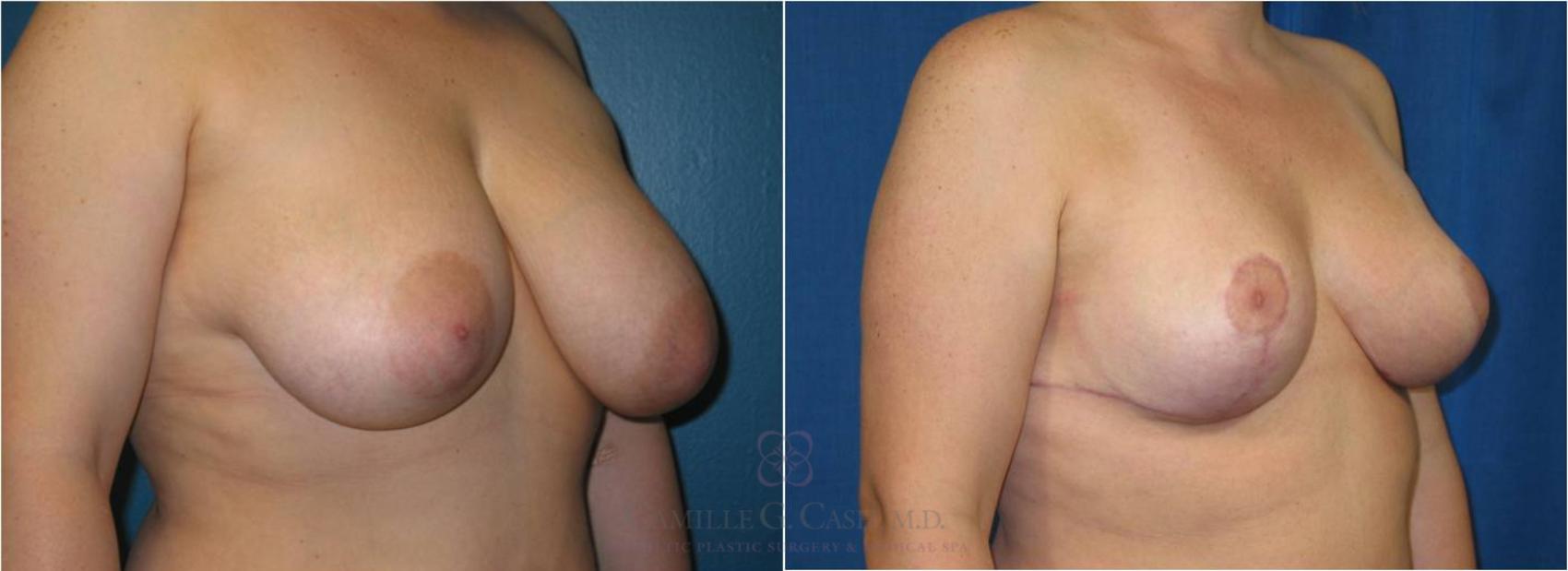 Before & After Breast Reduction Case 40 View #2 View in Houston, TX
