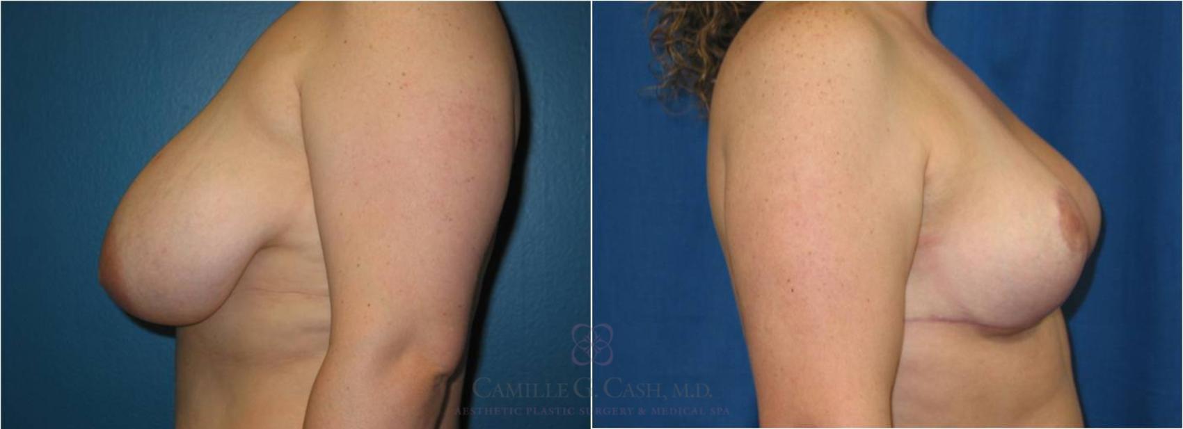 Before & After Breast Reduction Case 40 View #3 View in Houston, TX