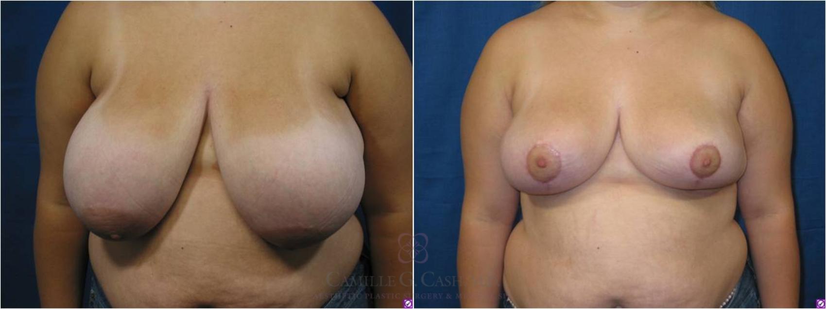 Before & After Breast Reduction Case 41 View #1 View in Houston, TX