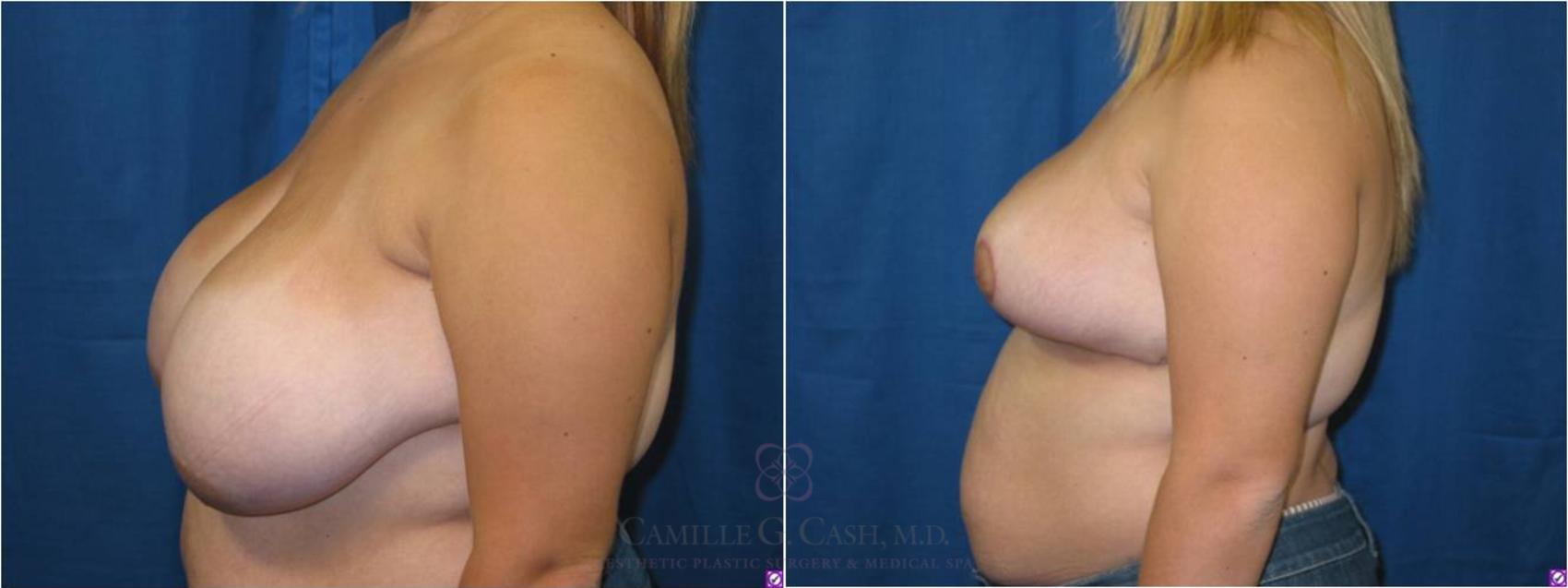Before & After Breast Reduction Case 41 View #2 View in Houston, TX