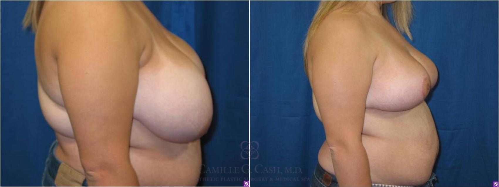 Before & After Breast Reduction Case 41 View #3 View in Houston, TX