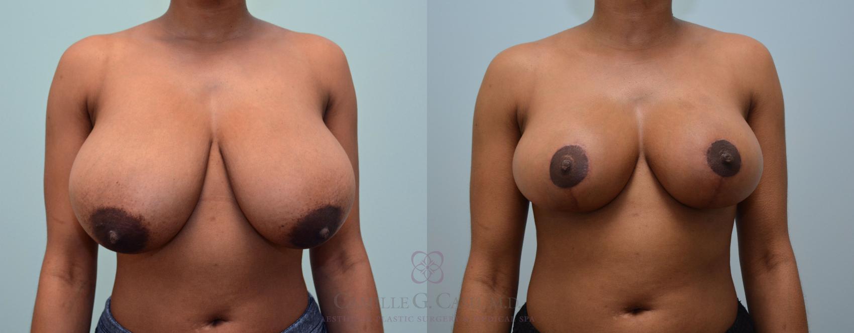 Before & After Breast Reduction Case 410 View #1 View in Houston, TX