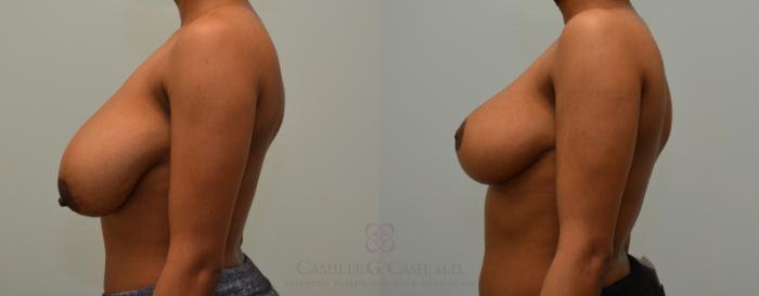 Before & After Breast Reduction Case 410 View #2 View in Houston, TX