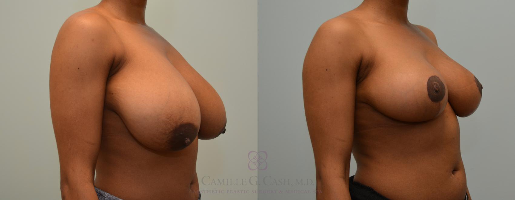 Before & After Breast Reduction Case 410 View #3 View in Houston, TX