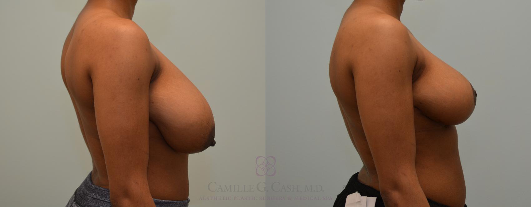 Before & After Breast Reduction Case 410 View #4 View in Houston, TX