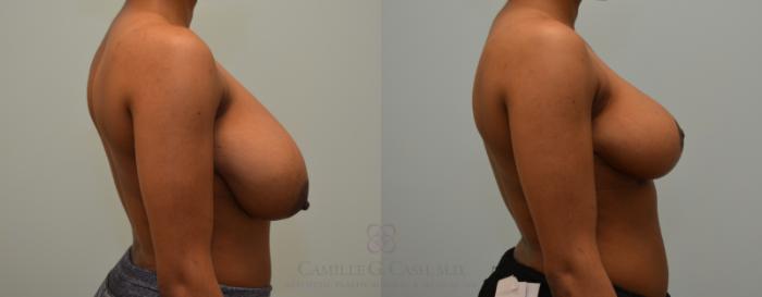 Before & After Breast Reduction Case 410 View #4 View in Houston, TX