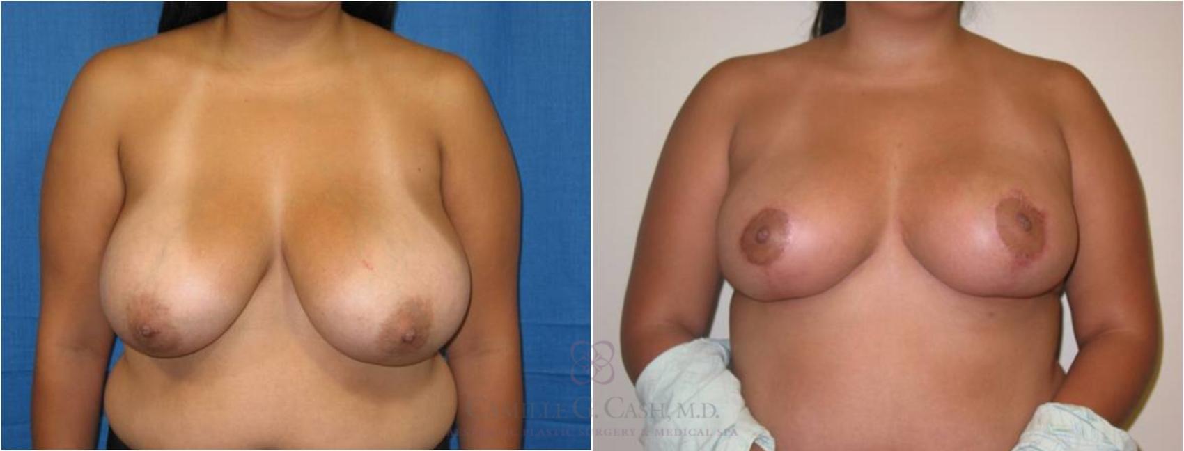Before & After Breast Reduction Case 43 View #1 View in Houston, TX