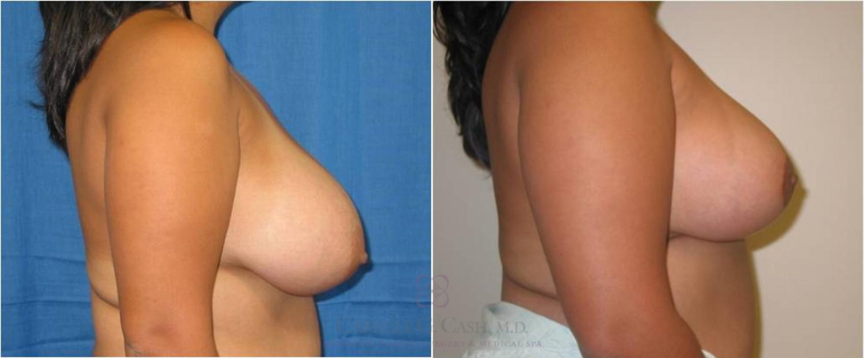 Before & After Breast Reduction Case 43 View #2 View in Houston, TX