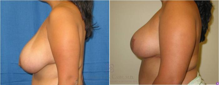 Before & After Breast Reduction Case 43 View #3 View in Houston, TX