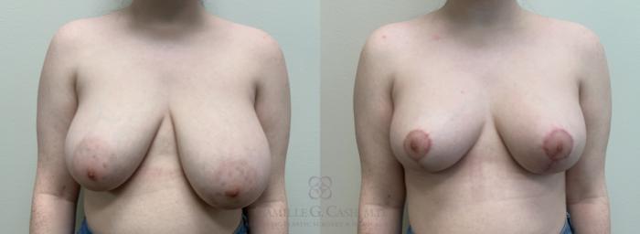 Before & After Breast Reduction Case 448 View #1 View in Houston, TX