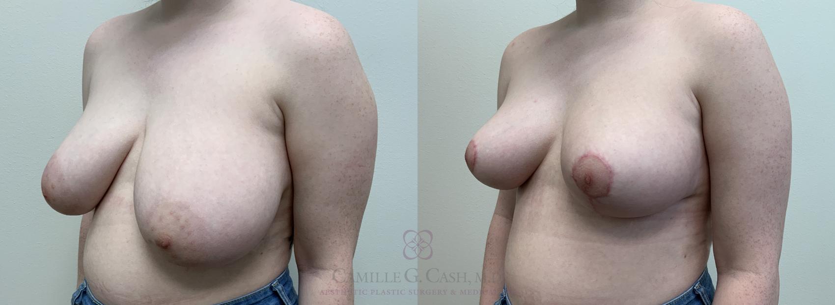 Before & After Breast Reduction Case 448 View #2 View in Houston, TX
